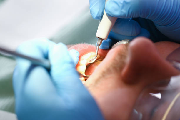 Best Emergency Dental Care for Abscessed Tooth in Cockeysville, MD